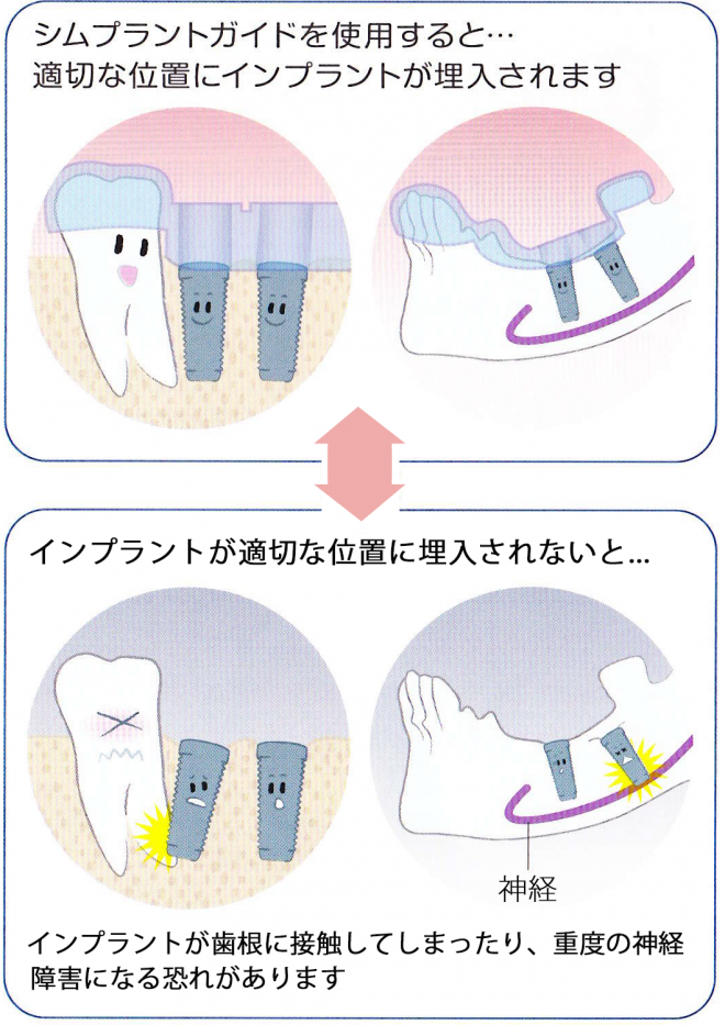 シムプラントガイドの説明画像