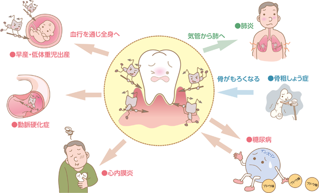 歯周病と心臓疾患・脳血管疾患