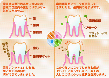 歯周病の進行段階