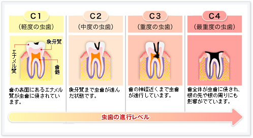 図解：虫歯の進行レベル