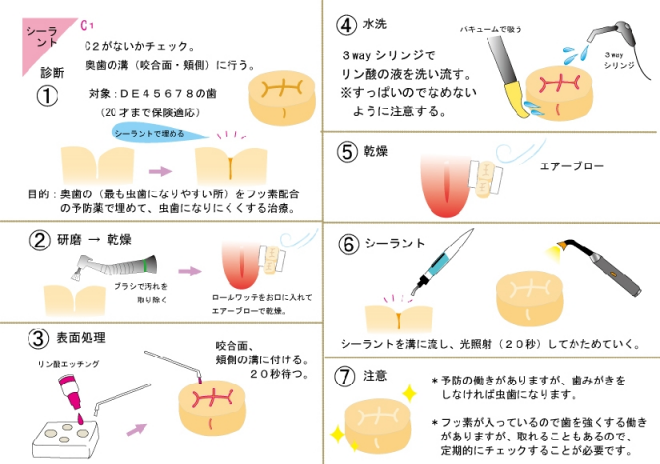 図解：シーラントの工程