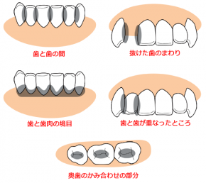 図解：磨き残しになりやすい歯