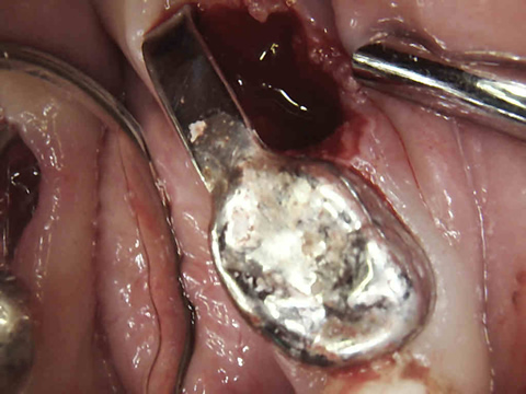 第一乳臼歯を抜歯後ディスタルシューをセット
