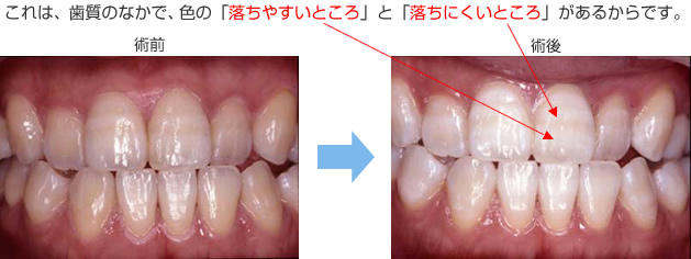 ホワイトニング施術後の縞