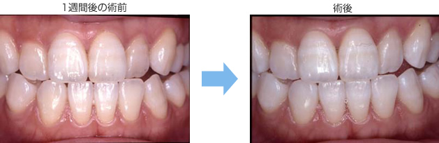 ホワイトニング施術後の縞