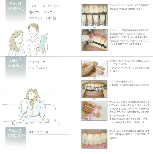 ホームホワイトニングのステップ