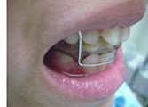 FKO：上下の歯を噛み合せる事で下顎の成長を促す装置（受け口や出っ歯を治す装置）