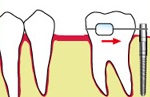 抜歯などの影響によって隙間ができ、大臼歯が手前に倒れこんでいます。