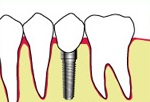 インプラントもしくはブリッジを施す