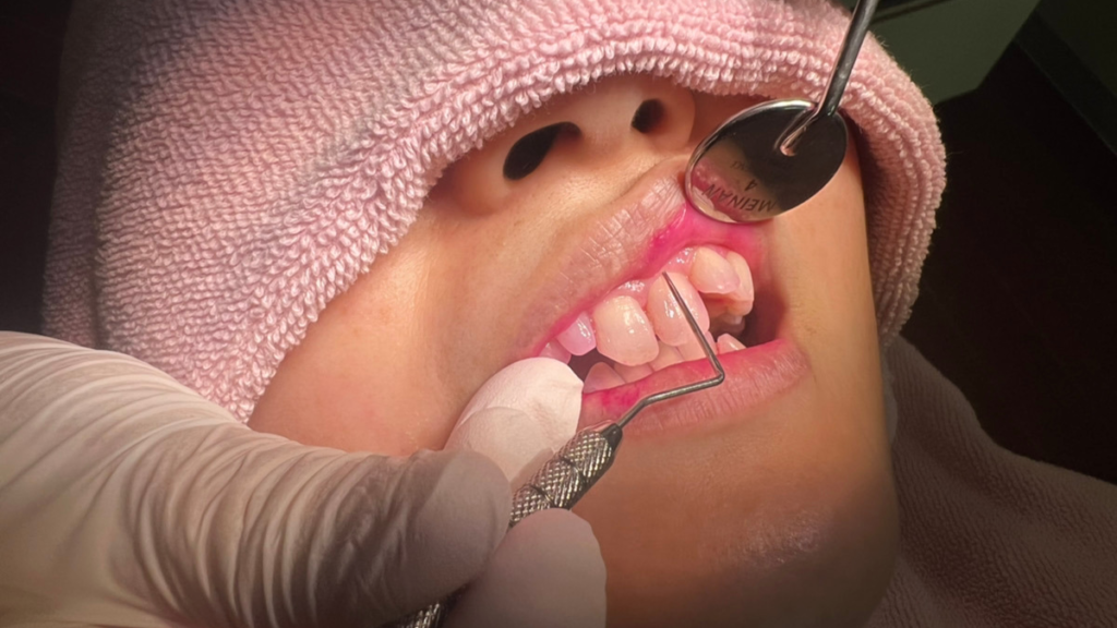 歯周病の検査の様子